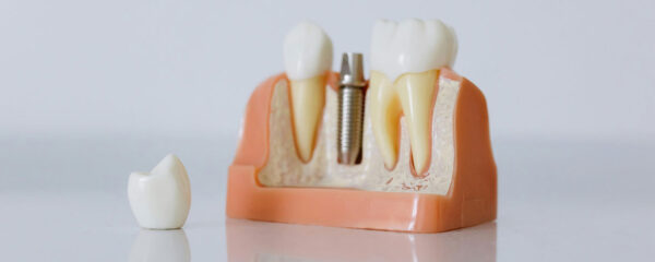 Les implants dentaires
