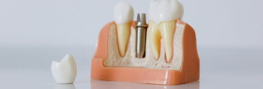 Les implants dentaires